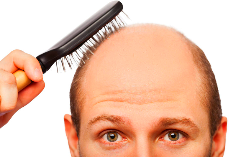 alopecia areata e calvizie soluzioni rimedi e come funziona dal punto di vista scientifico